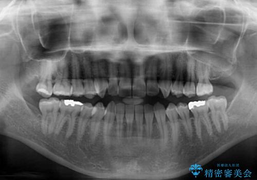 前歯のデコボコ インビザラインによる矯正治療の治療前