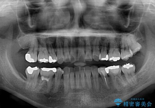 矯正の後戻りの改善と銀歯をセラミックにの治療前