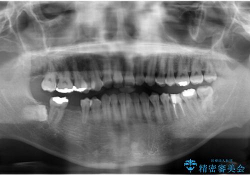 初めてのインプラント 手術は怖いので、寝ている間に終わりたいの治療前