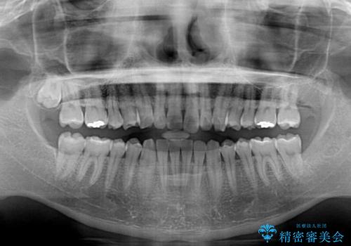 気になる後戻り 前歯をインビザライン・ライトで改善の治療中