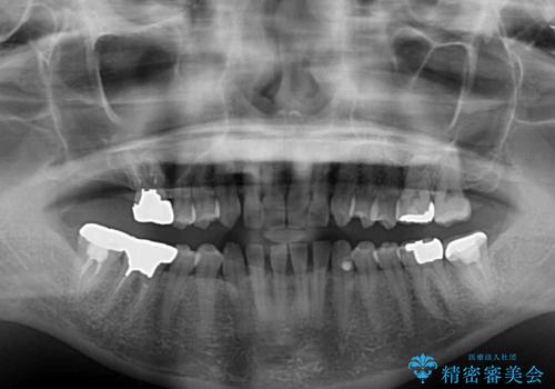隙間だらけの歯列をきれいに インビザライン矯正とセラミック補綴治療の治療前
