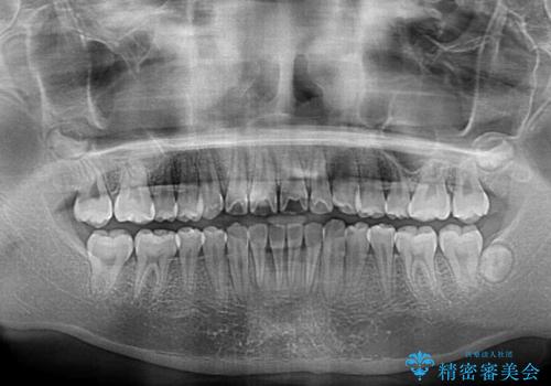 前歯のデコボコを短期間で治療 目立たないワイヤー矯正の治療後