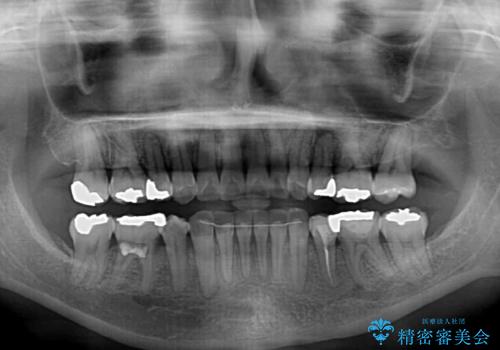 矯正の後戻りの改善と銀歯をセラミックにの治療後