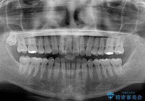 気になる後戻り 前歯をインビザライン・ライトで改善の治療中