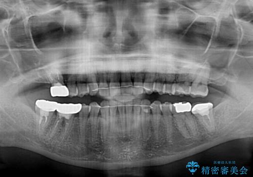 隙間だらけの歯列をきれいに　インビザライン矯正とセラミック補綴治療の治療後