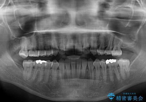 前歯のデコボコ インビザラインによる矯正治療の治療後