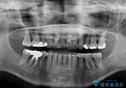 閉じにくい口元を改善したい ワイヤー装置での抜歯矯正の治療後