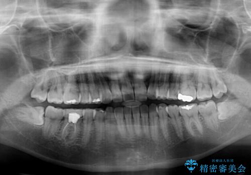 気になる上の歯を改善 インビザライン矯正の治療後