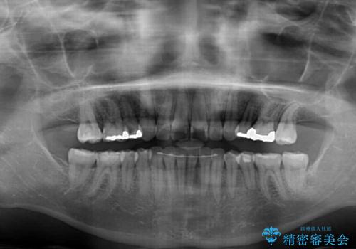 前歯の突出を軽減　インビザラインによる抜歯矯正の治療後