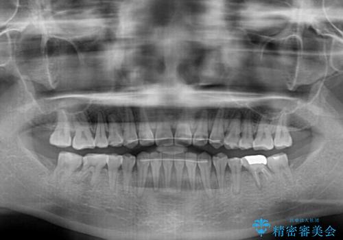 隙間の空いた前歯を治したい　インビザライン矯正治療の治療後
