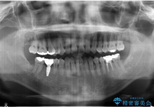 初めてのインプラント 手術は怖いので、寝ている間に終わりたいの治療後