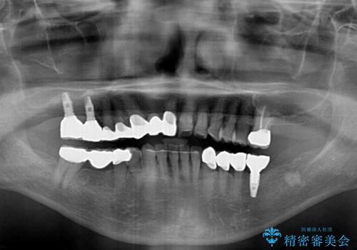 歯周病改善のための総合歯科治療の治療後