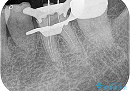 奥歯がズキズキ痛い 根管治療の治療中
