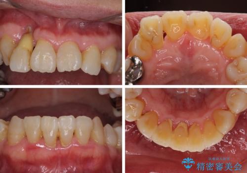 歯周病改善のための総合歯科治療の治療前