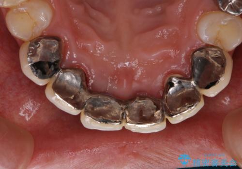 1年ぶりのPMTCの治療後