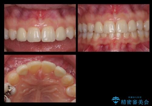 前歯を整えたい 小さい前歯がある 矯正・セラミック併用で美しく インビザラインでも抜歯矯正できますの治療後