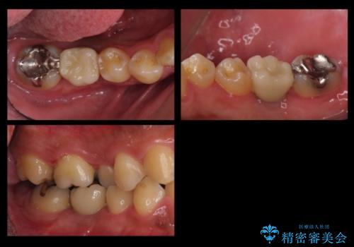 初めてのインプラント 手術は怖いので、寝ている間に終わりたいの治療後