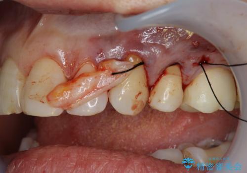 歯磨きすると歯がしみる 結合組織移植による根面被覆の治療中