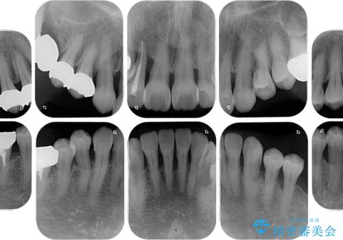 歯周病改善のための総合歯科治療の治療前