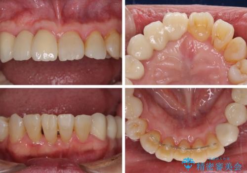 歯周病改善のための総合歯科治療の治療後