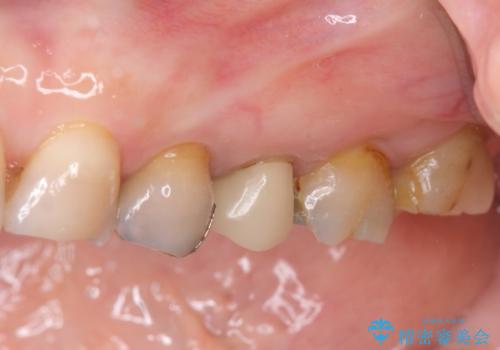 放置した虫歯 根管治療 フルジルコニアクラウンの治療前