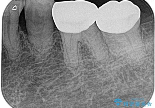 奥歯がズキズキ痛い 根管治療の治療前