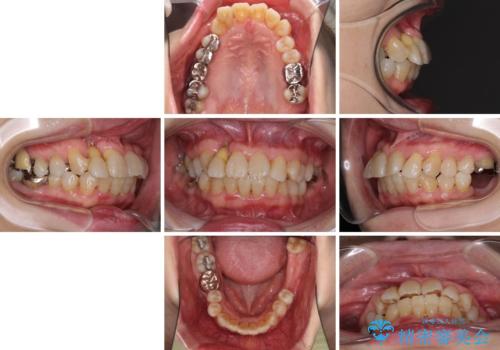 歯周病改善のための総合歯科治療の治療前