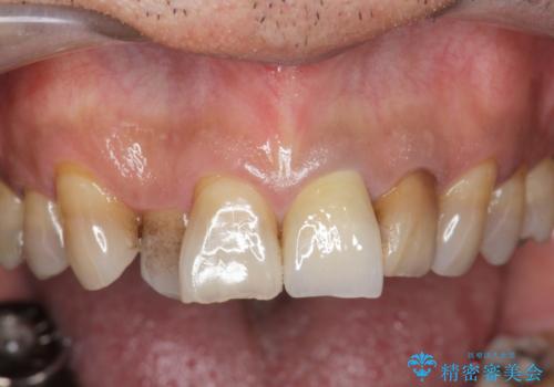 [前歯　セラミック治療]  すぐに前歯が取れる きちんと治療して欲しいの治療後