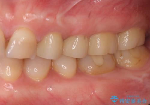 放置した虫歯 根管治療 フルジルコニアクラウンの治療後