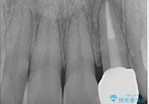 前歯の変色 オールセラミッククラウンの治療後