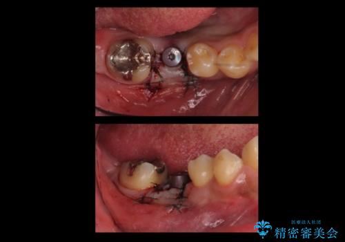 初めてのインプラント 手術は怖いので、寝ている間に終わりたいの治療中