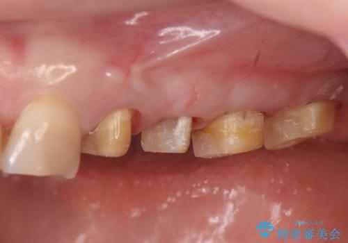 放置した虫歯 根管治療 フルジルコニアクラウンの治療中