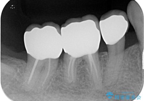 虫歯の治療　オールセラミッククラウンの治療後