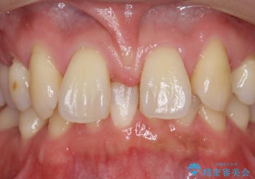 オールセラミッククラウン 部分矯正とセラミックによる前歯部の見た目の改善の治療前