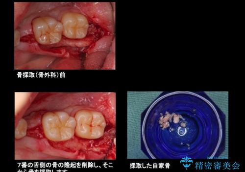20代男性 奥歯のインプラント 自分の骨を移植の治療中