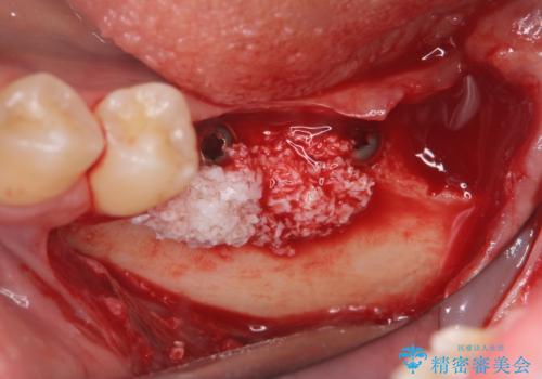 他院で断られた骨造成を伴うインプラント治療の治療中