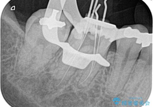 【根管治療】昨日から眠れないぐらい歯が痛いの治療前