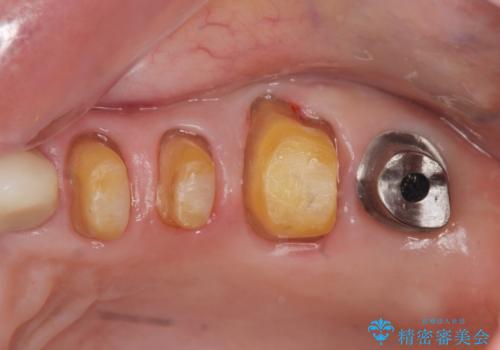 歯ぎしりに抵抗する歯周補綴 インプラント補綴の治療中
