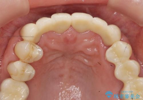 不自然な前歯ブリッジ ジルコニアブリッジによるやり替えの治療後