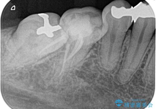 【根管治療】昨日から眠れないぐらい歯が痛いの治療後
