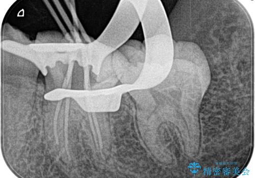 【根管治療】冷たいもので激痛の治療後