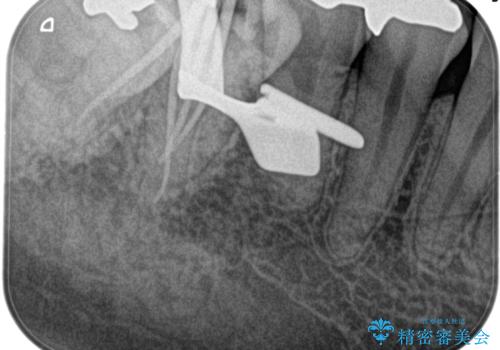 【根管治療】昨日から眠れないぐらい歯が痛いの治療後