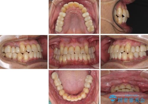 歯列不正と歯周病 総合歯科治療による全顎治療の治療中