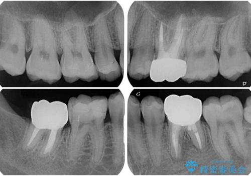 銀歯を白くしたい セラミックによる審美歯科治療の治療後