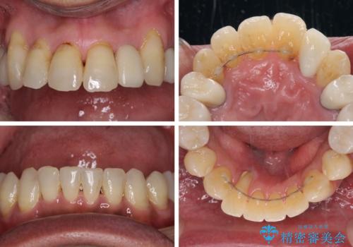 歯列不正と歯周病 総合歯科治療による全顎治療の治療後