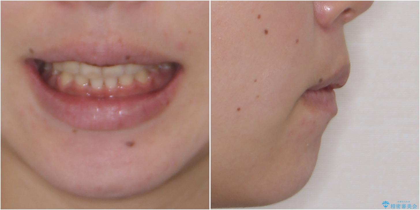 口元の突出感を改善 ワイヤー装置による抜歯矯正の治療後(顔貌)