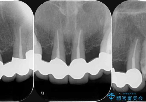 不自然な前歯ブリッジ ジルコニアブリッジによるやり替えの治療前
