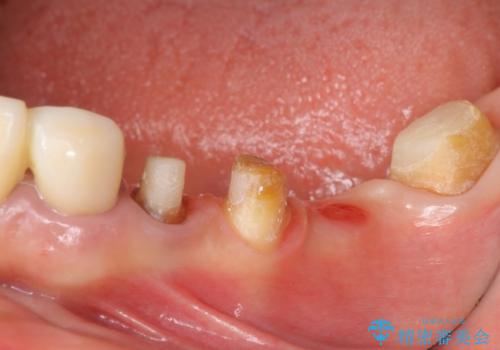 清掃しづらく、見た目の気になるブリッジの治療中