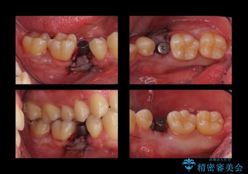 20代男性 奥歯のインプラント 自分の骨を移植の治療中