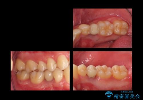 20代男性 奥歯のインプラント 自分の骨を移植の症例 治療後